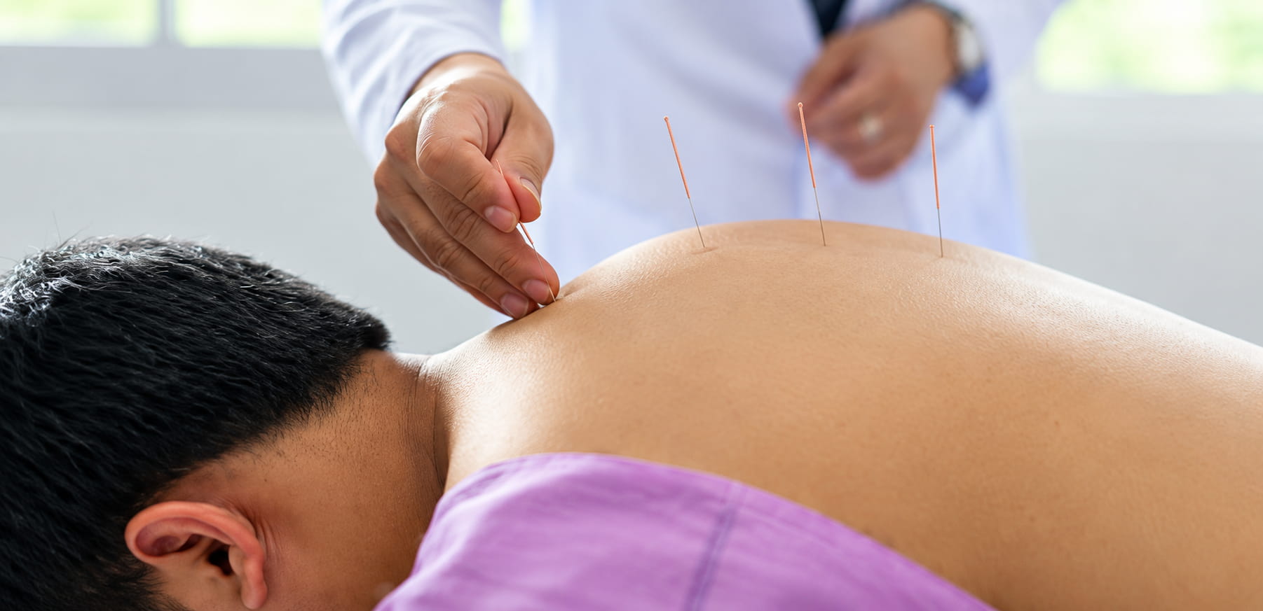 Acupuncture