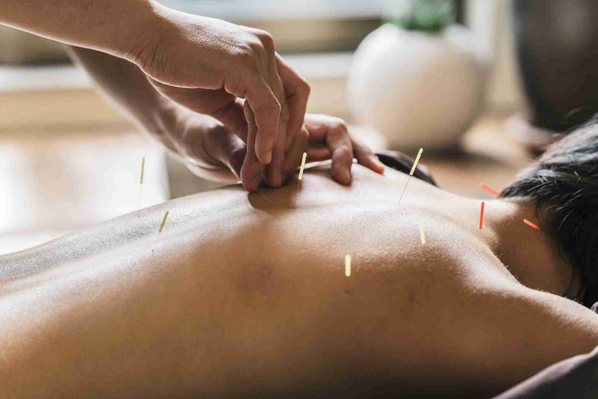 Cupping Therapy